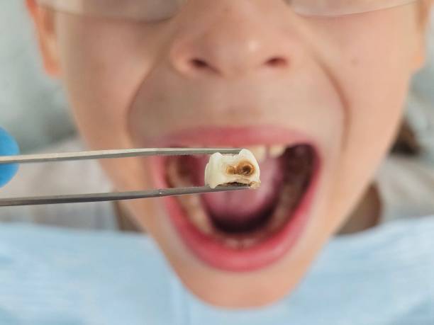 Best Emergency Wisdom Teeth Removal in Morse, LA